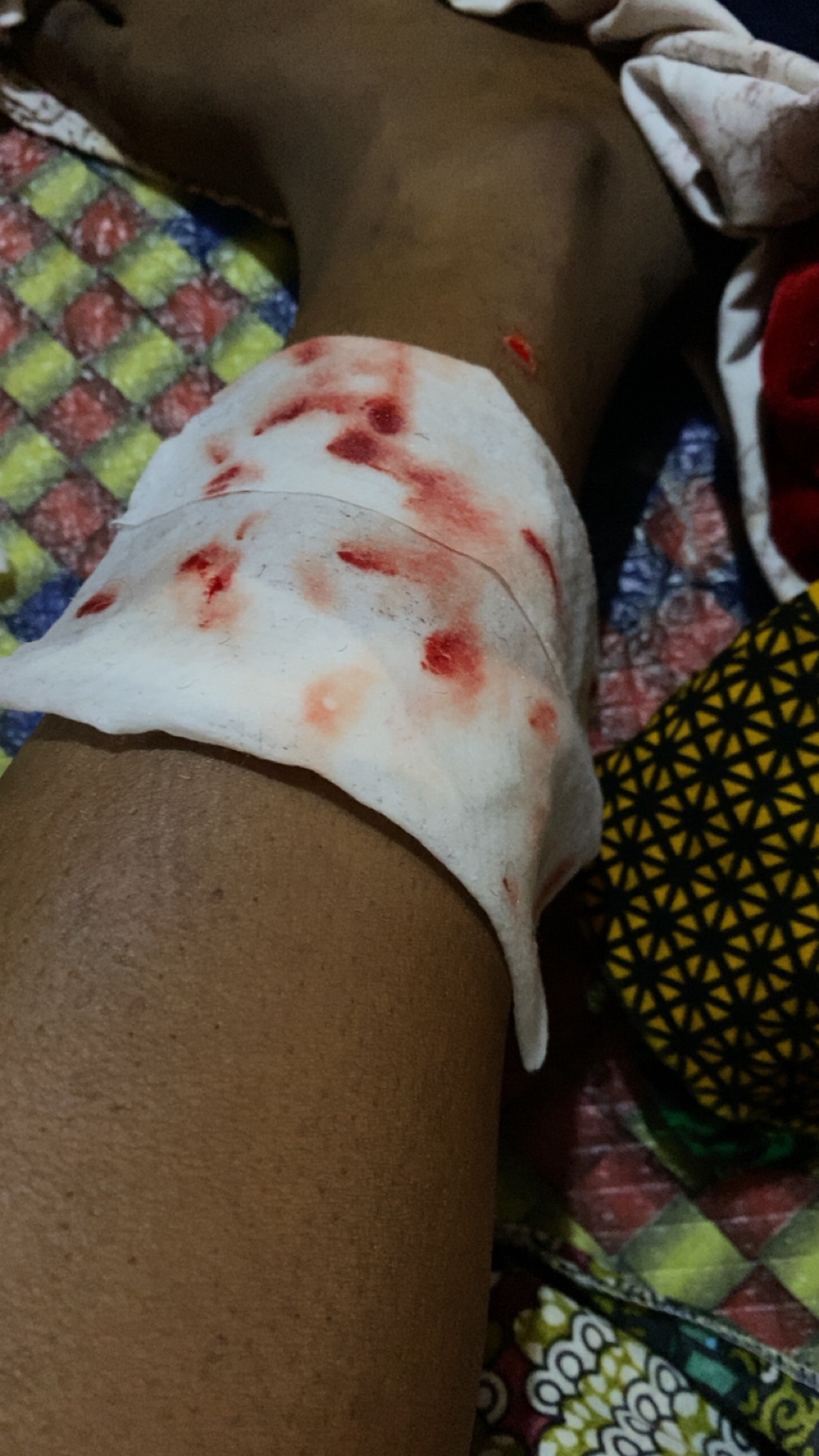 Treating broken leg